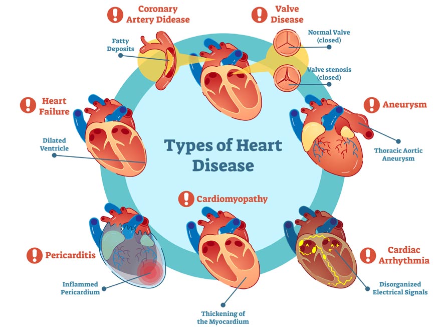 Heart disease types