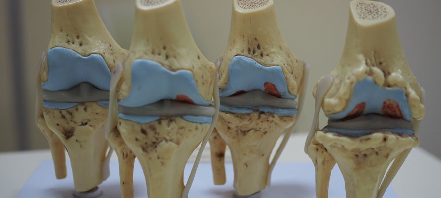 Subchondral Sclerosis Causes
